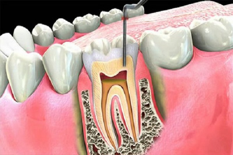 Hình ảnh điều trị tủy răng tại Nha khoa SV quận 3