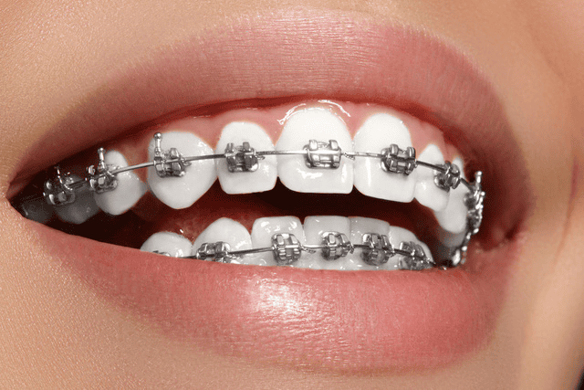 Hình ảnh niềng răng mắc cài kim loại tại nha khoa SV quận 3