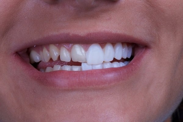 Dán sứ Veneer có tính thẩm mỹ cao