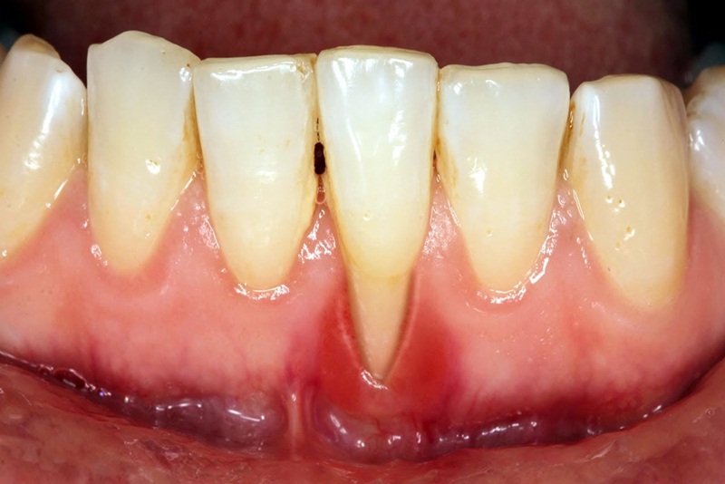 Viêm nướu nặng có thể cảm thấy răng mình bị lung lay