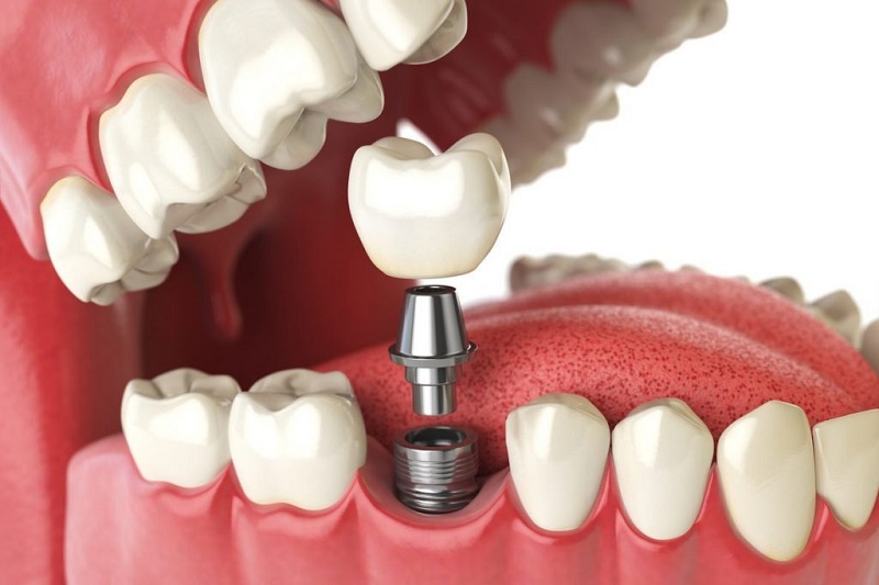 Hình ảnh trồng răng Implant