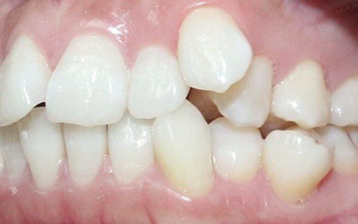 Hình ảnh minh họa răng bị lệch lạc 