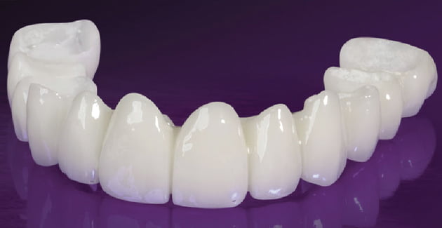 Hình ảnh giới thiệu răng toàn sứ Cercon HT