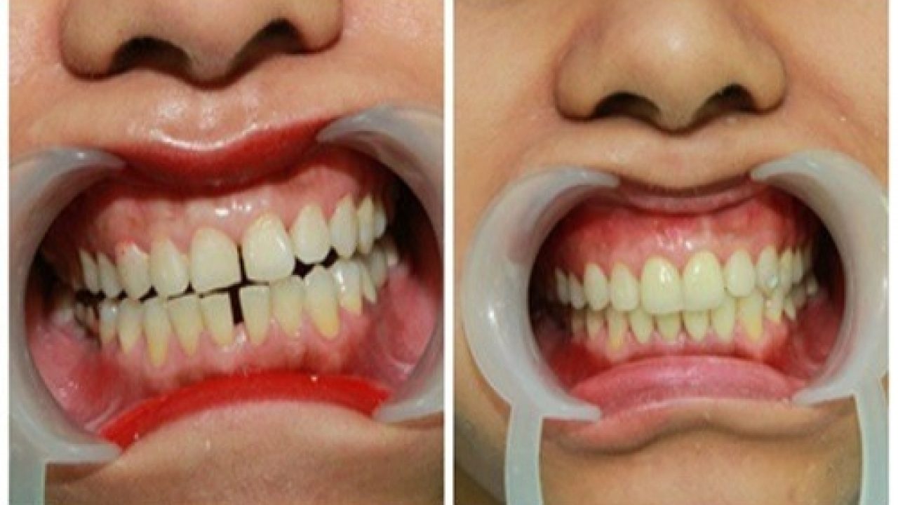 Có nhiều nguyên nhân dẫn đến răng thưa, kẻ hở: di truyền, sâu răng, viêm nướu....