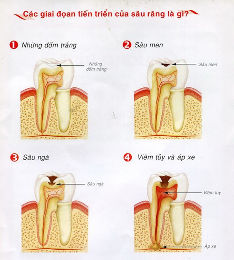 Hình ảnh các giai đoạn tiến triển của sâu răng