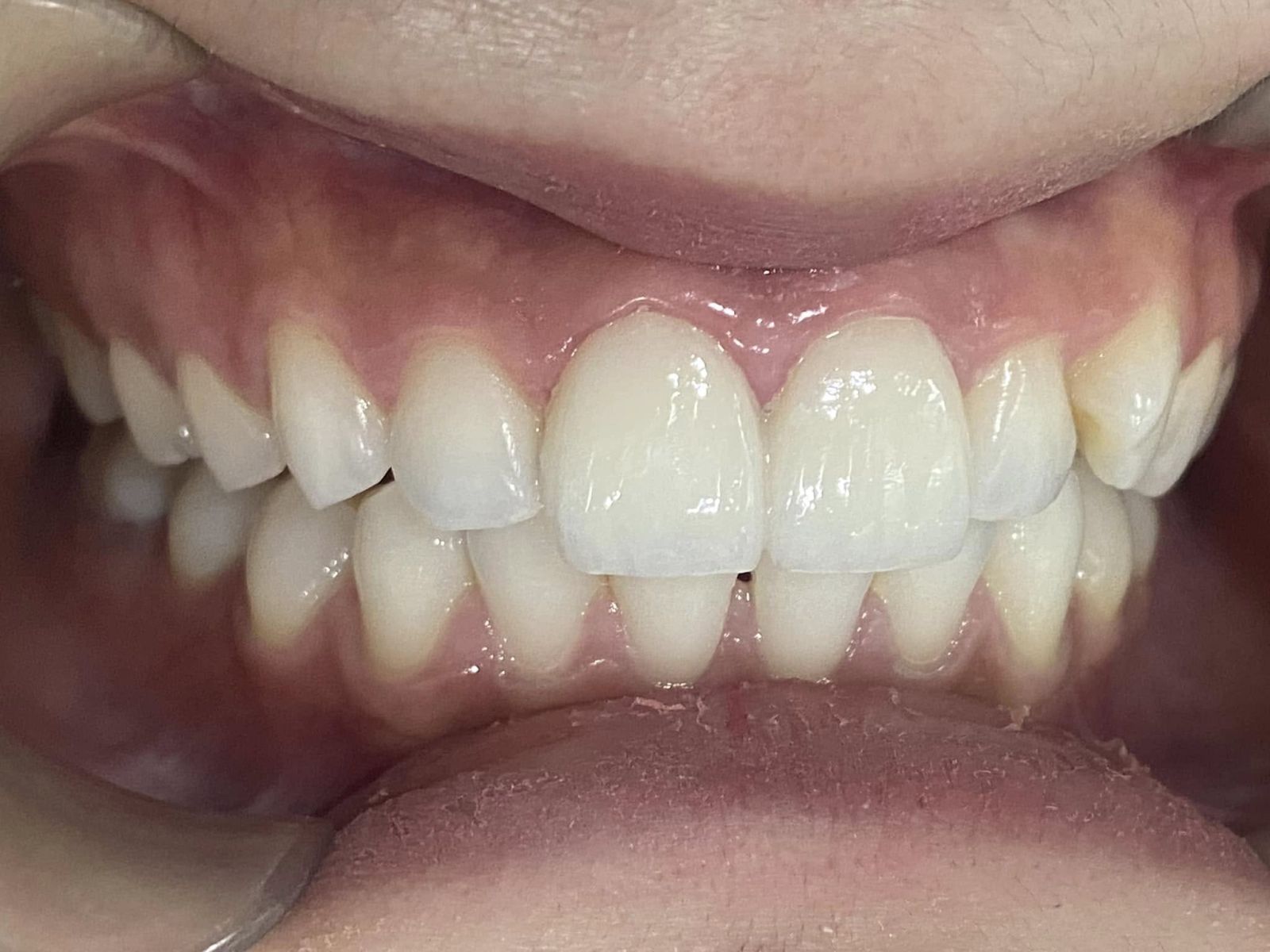 Hình ảnh khách hàng dán sứ Veneer tại Nha khoa SV quận 3