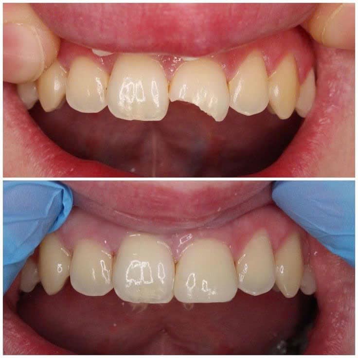 Hình ảnh dịch vụ trám răng thẩm mỹ tại Nha khoa SV quận 3