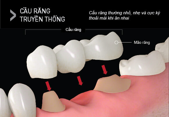 Hình ảnh bắc cầu răng sứ truyền thống tại Nha khoa SV quận 3