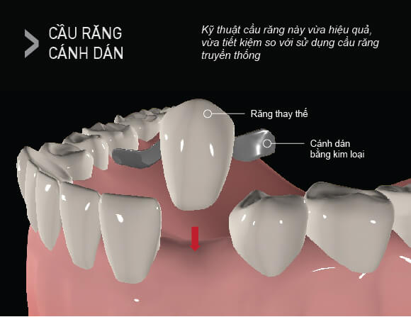 Hình ảnh giới thiệu về cầu răng cánh dán (Maryland bridge)
