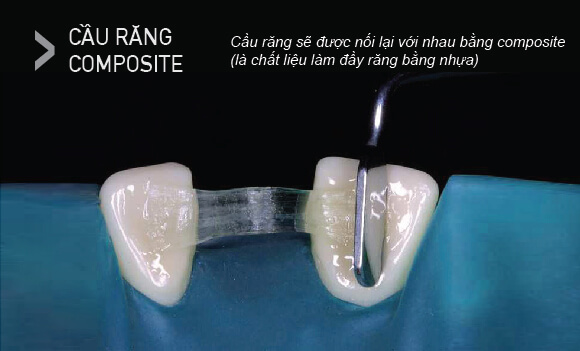 Hình ảnh giới thiệu về cầu răng Composite