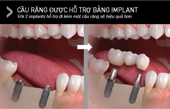 Cầu răng có Implant hỗ trợ (Implant-Supported Bridges)