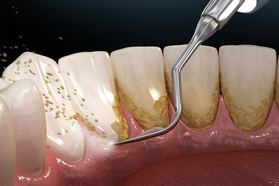 Hình ảnh giới thiệu về cạo vôi răng: Nha khoa SV quận 3