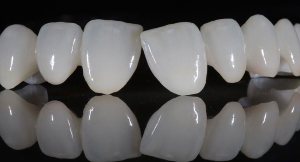Hình ảnh giới thiệu răng sứ E.max: Nha khoa SV quận 3