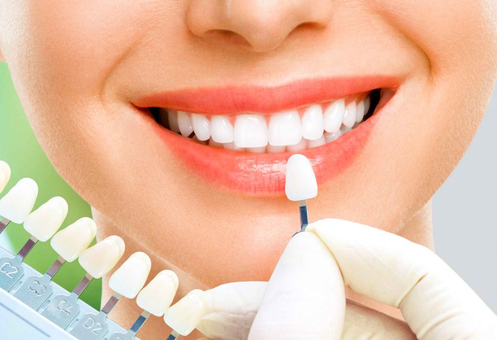 Hình ảnh dán sứ nha khoa SV