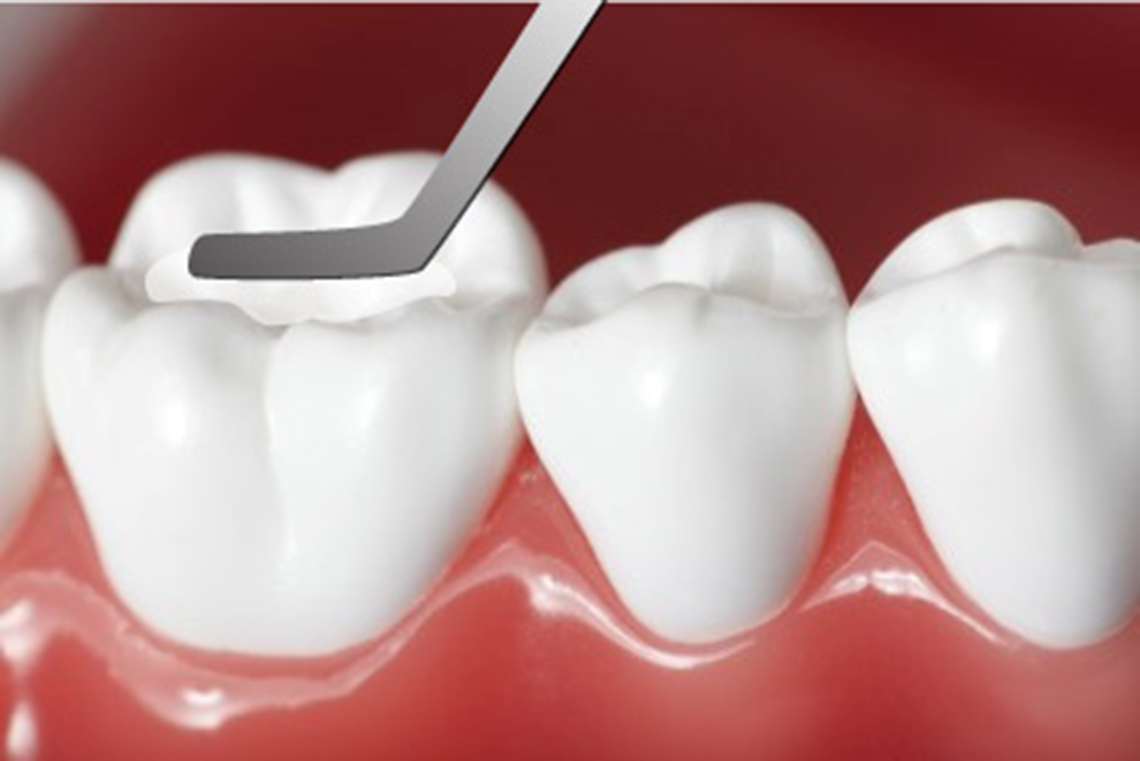 Trám răng composite có tính thẩm mỹ cao  tại Nha khoa SV quận 3