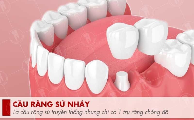 Hình ảnh phương pháp cầu răng sứ nhảy tại Nha khoa SV quận 3