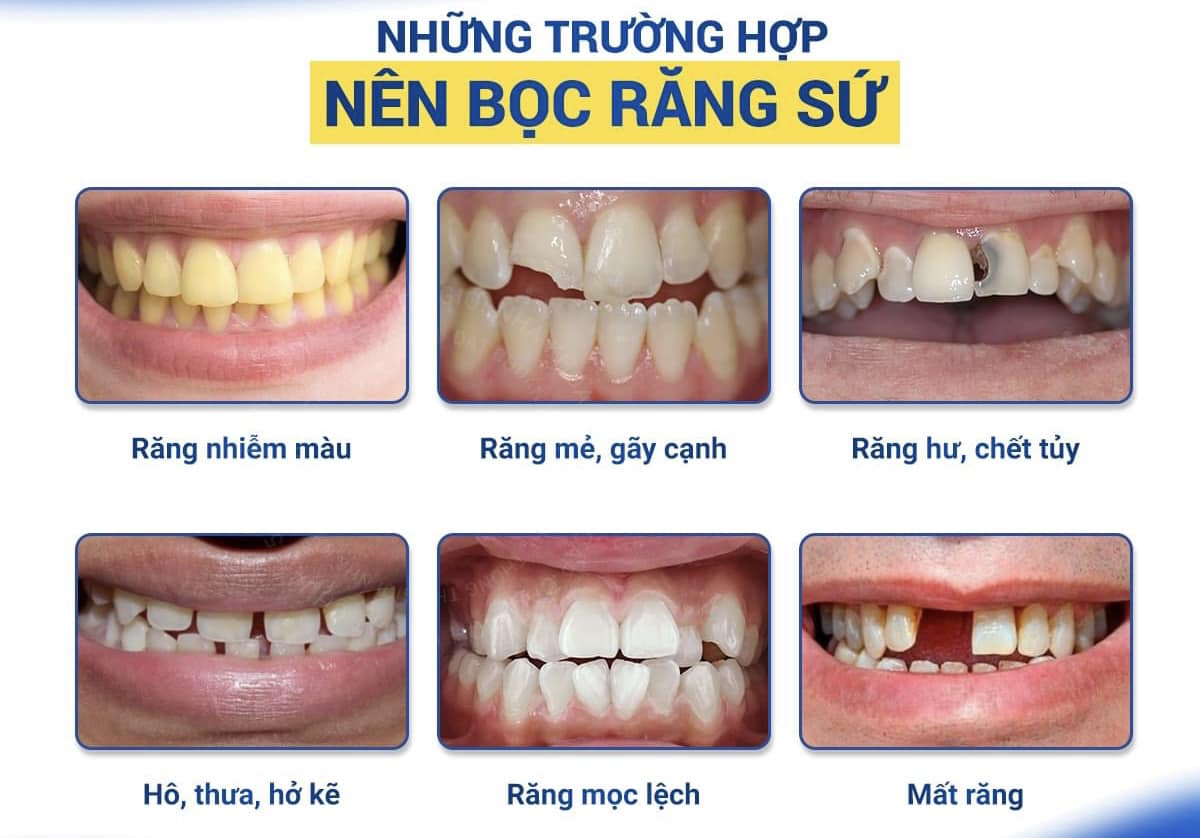 Bọc răng sứ nha khoa quận 3