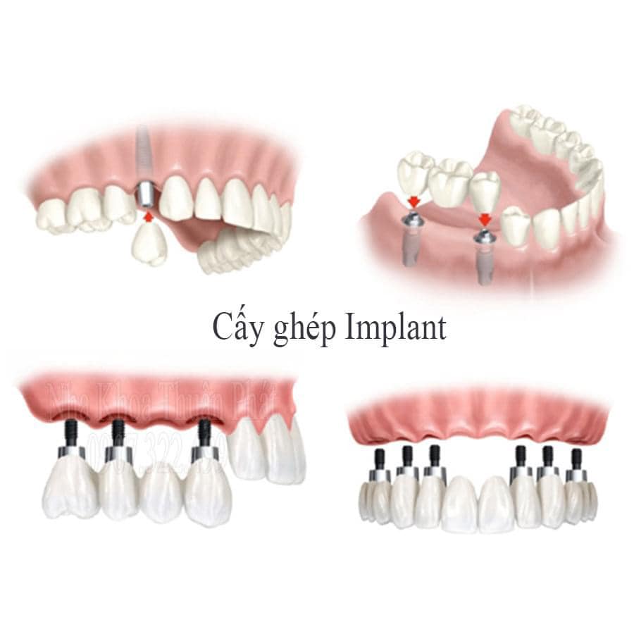 Cấy ghép implamt quận 3