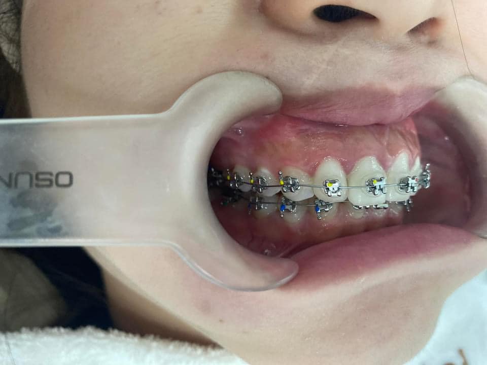 Nha khoa sv niền răng thẩm mỹ quận 3