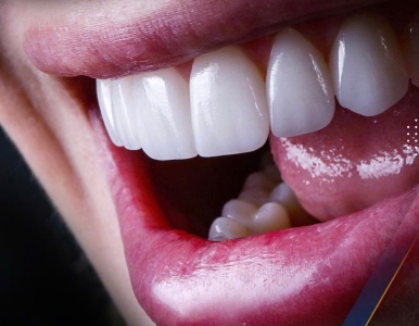 Dán sứ veneer quận 3