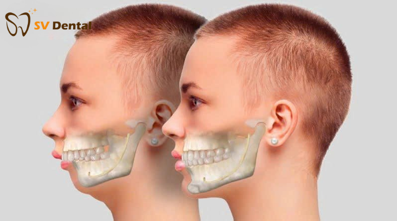 hình ảnh răng hô nặng 