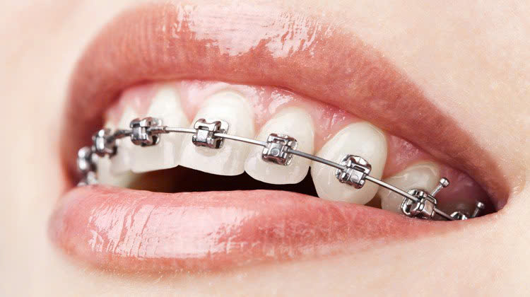 Hình ảnh niềng răng mắc cài kim loại