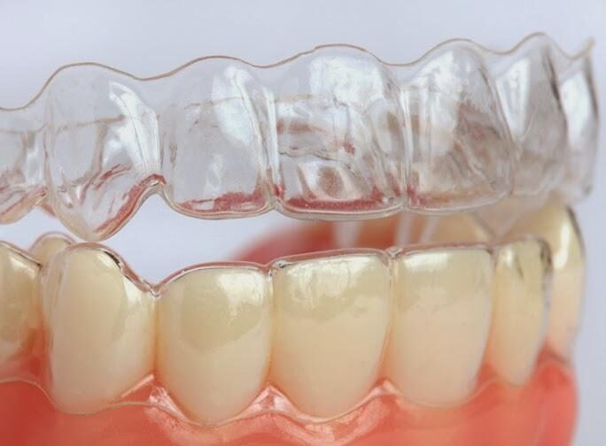 Hình ảnh phương pháp niềng răng trong suốt 