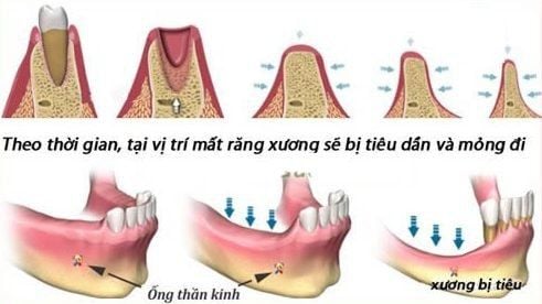 Tình trạng xương hàm của bệnh nhân cũng là một yếu tố quyết định đến sự thành công của implant.