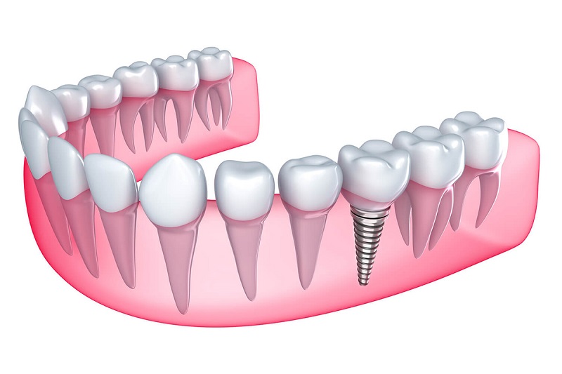 Cấy ghép Implant là phương pháp phục hình răng mất rất hiệu quả