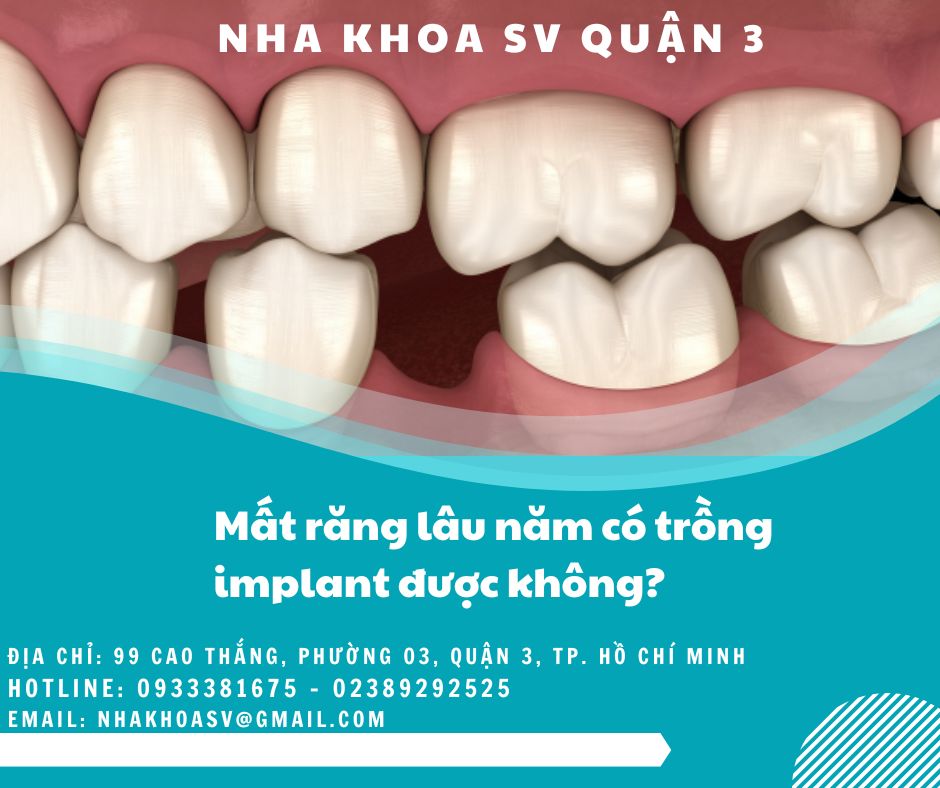 Mất răng lâu năm có trồng implant được không?
