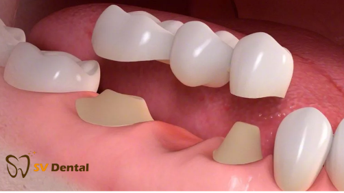 Trồng răng Implant công nghệ Pháp
