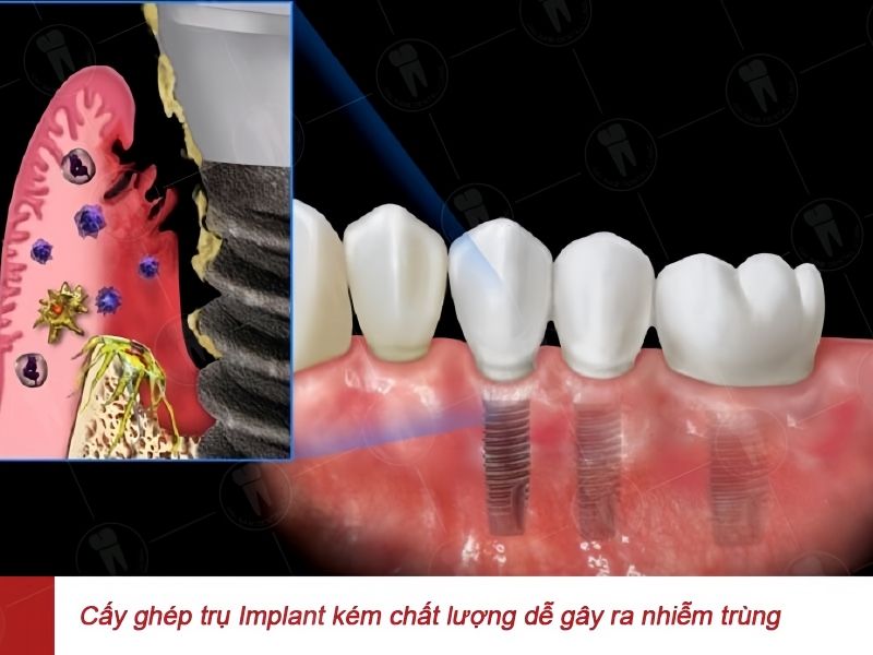 Dùng trụ implant kém chất lượng dễ dẫn đến tình trạng trụ implant bị đào thải