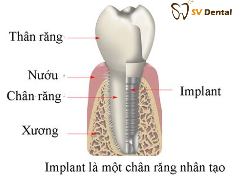 Cấu trúc của răng implant với răng thật