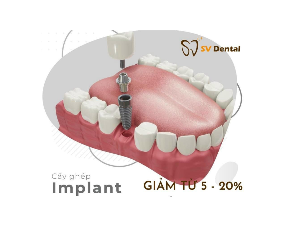  trồng răng Implant.