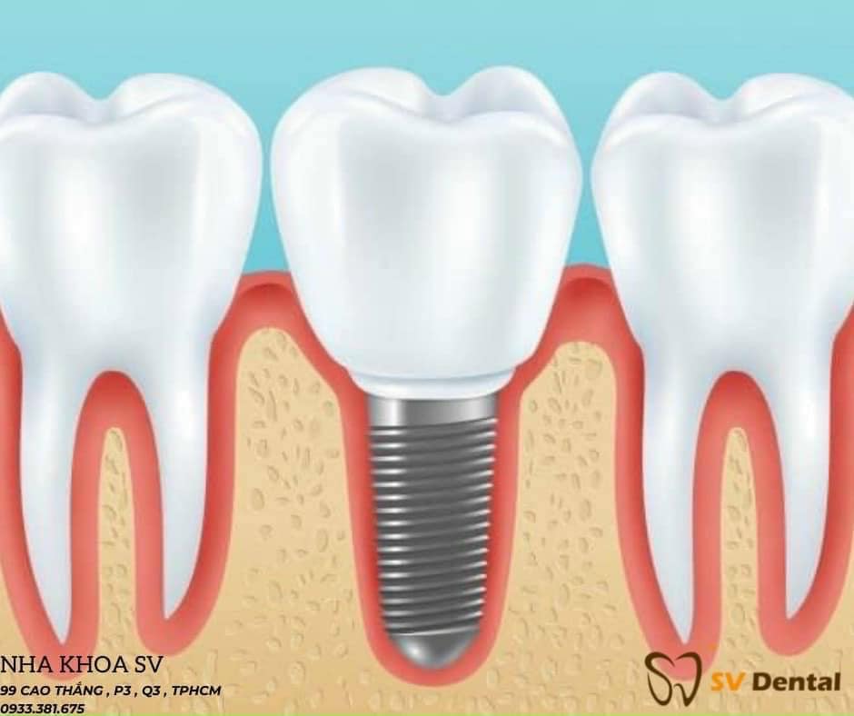 Mất răng và nên sử dụng phương pháp trồng Implant