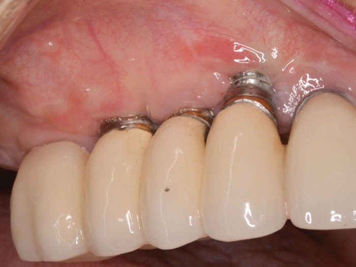 Hình ảnh trụ implant trồi lên