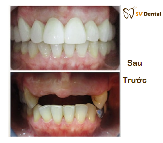 Kết quả thẩm mỹ trước vào sau khi trồng Implant
