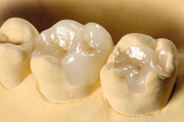 Hình ảnh trám răng bằng miếng sứ tại nha khoa SV quận 3