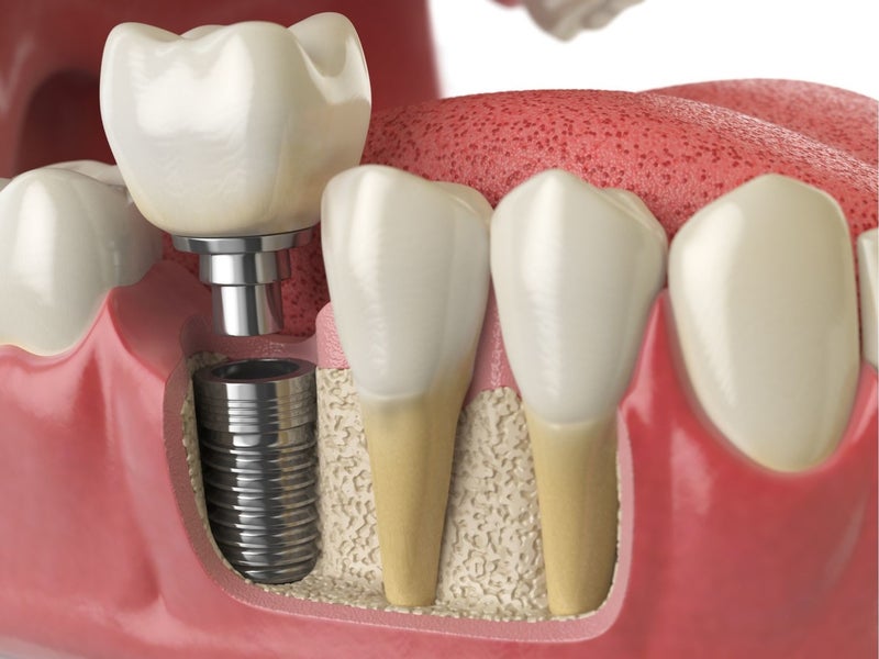 Cấy ghép implant là một lựa chọn tốt cho việc trồng lại răng số 7