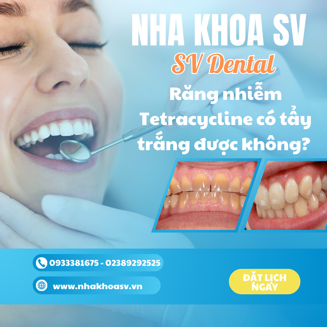 Răng nhiễm Tetracycline có tẩy trắng được không?