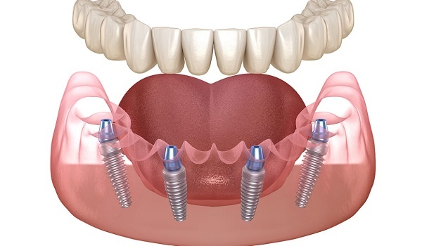 Hình ảnh giới thiệu phương pháp trồng răng Implant All On 4