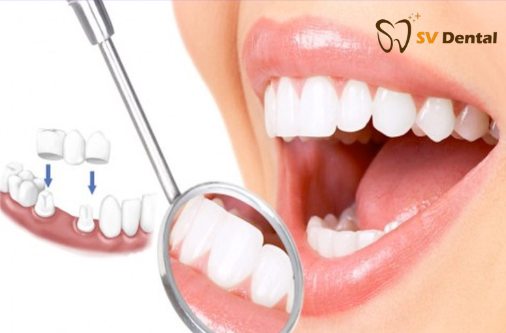 Hình ảnh bọc răng sứ