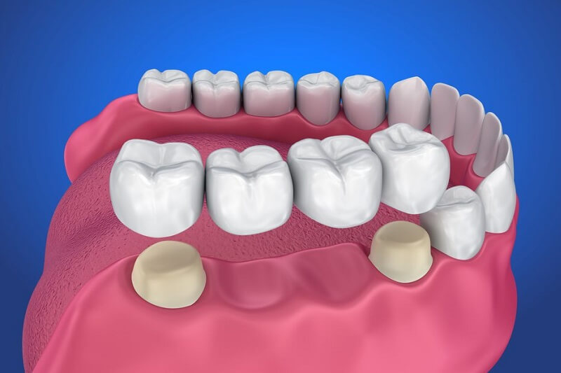 Hình ảnh minh họa phương pháp cầu răng sứ tại Nha khoa SV quận 3