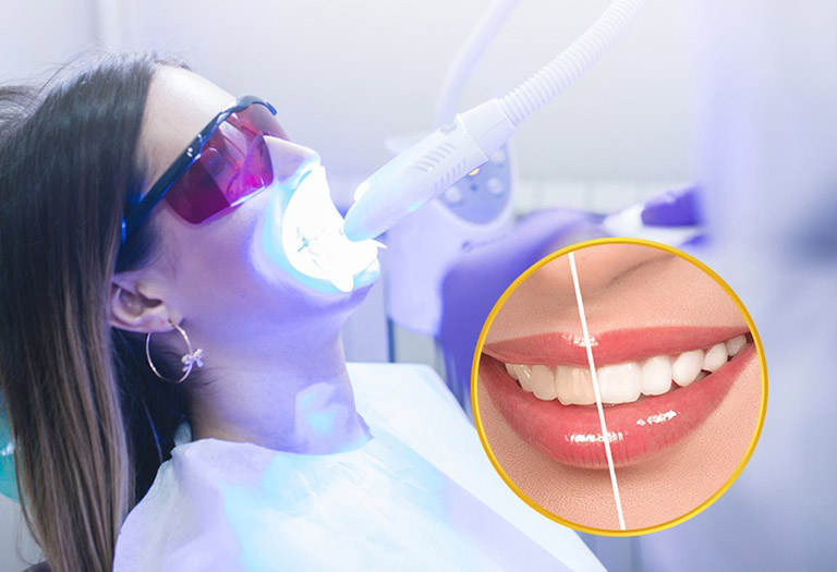 Khi nào nên tẩy trăng răng?