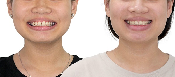 Hình ảnh trước và sau khi niềng răng hô nhẹ tại Nha khoa SV quận 3