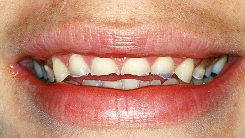 Hình ảnh bị mòn răng 