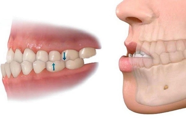 Hình ảnh minh họa về răng móm