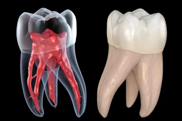 Bọc răng sứ giúp phục hồi sự thẩm mỹ cho hàm răng và bảo vệ răng sau khi lấy tủy