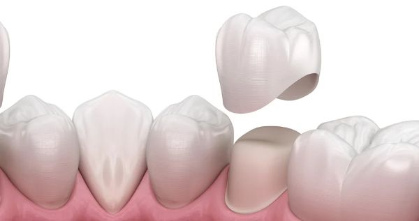 Hình ảnh minh họa về phương pháp bọc răng sứ tại Nha khoa SV quận 3