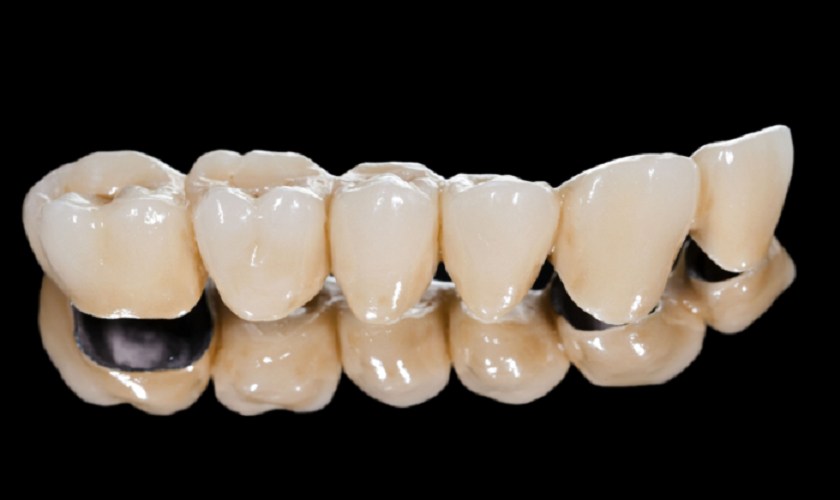 Hình ảnh minh họa về răng sứ titan